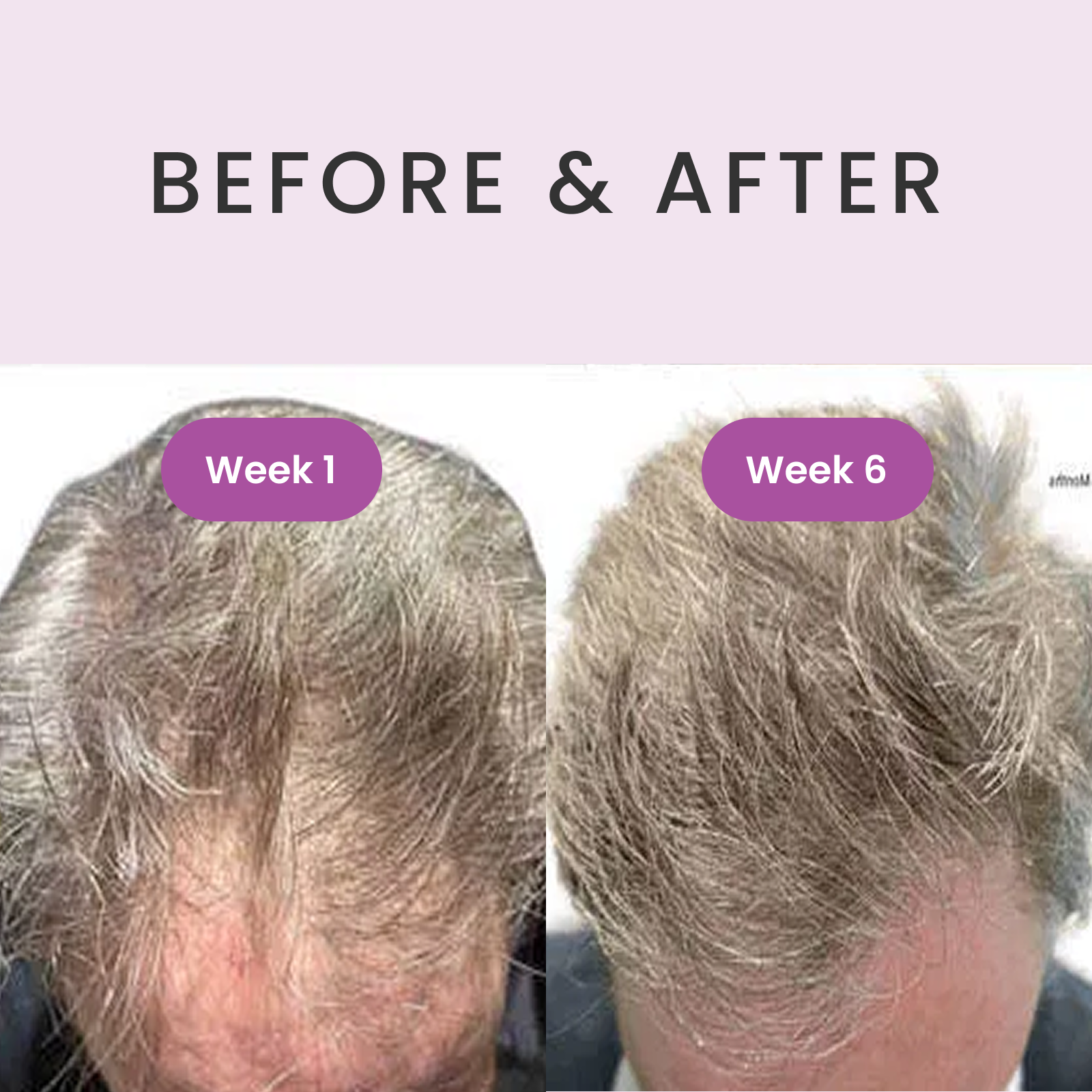 RevivHair Max Hair Stimulating Serum with 5% Redensyl