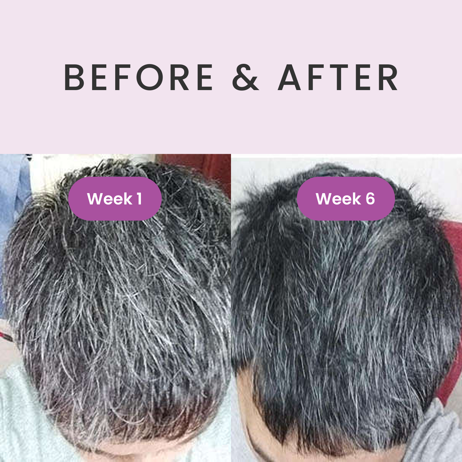 glutathione grey hair study Reversing Gray Hair: Inspiring the Development of New Therapies Through Research on Pigmentation and Repigmentation Progress I've worked with patients who